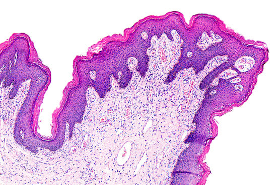 Skin papilloma of a human